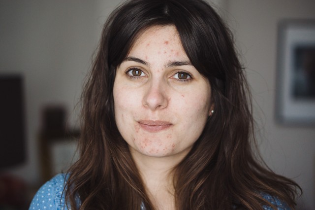 comment n avoir plus d acne